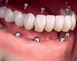 Ponte fixa sobre implantes — ideal quando faltam vários dentes seguidos