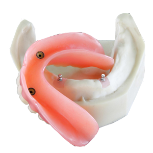Overdenture — dentadura sobre implantes com encaixe Divinópolis