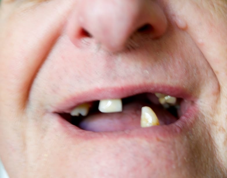 Reabilitação oral em Divinópolis — paciente com perda parcial de dentes
