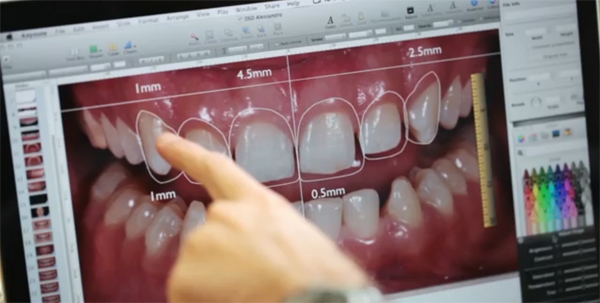 Planejamento digital do sorriso — periodontia estética Divinópolis MG