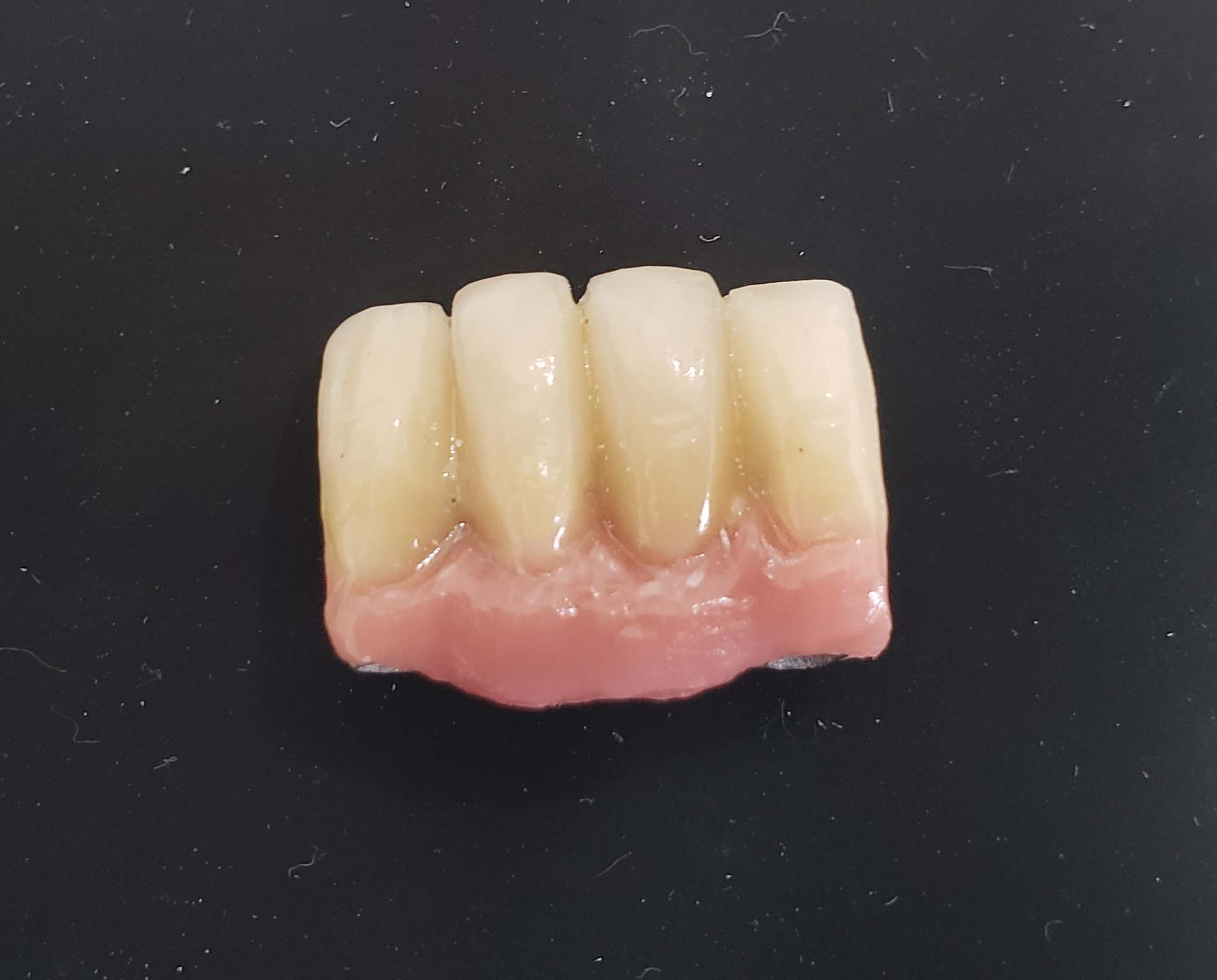 Ponte fixa sobre implantes — caso finalizado