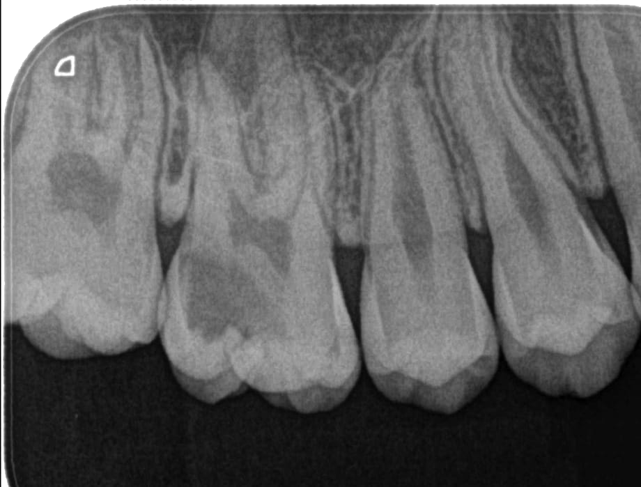 Radiografia periapical mostrando cárie oculta em dente