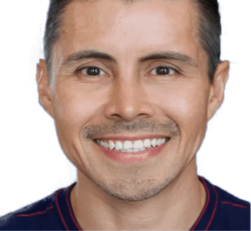 Depois — sorriso gengival após correção cirúrgica