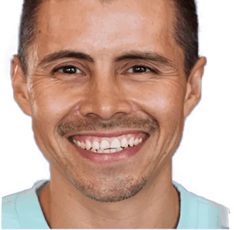 Antes — sorriso gengival antes da correção