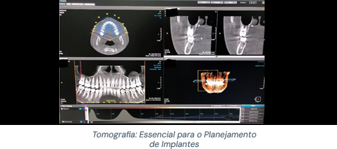 Tomografia computadorizada para planejamento de implante dentário Divinópolis