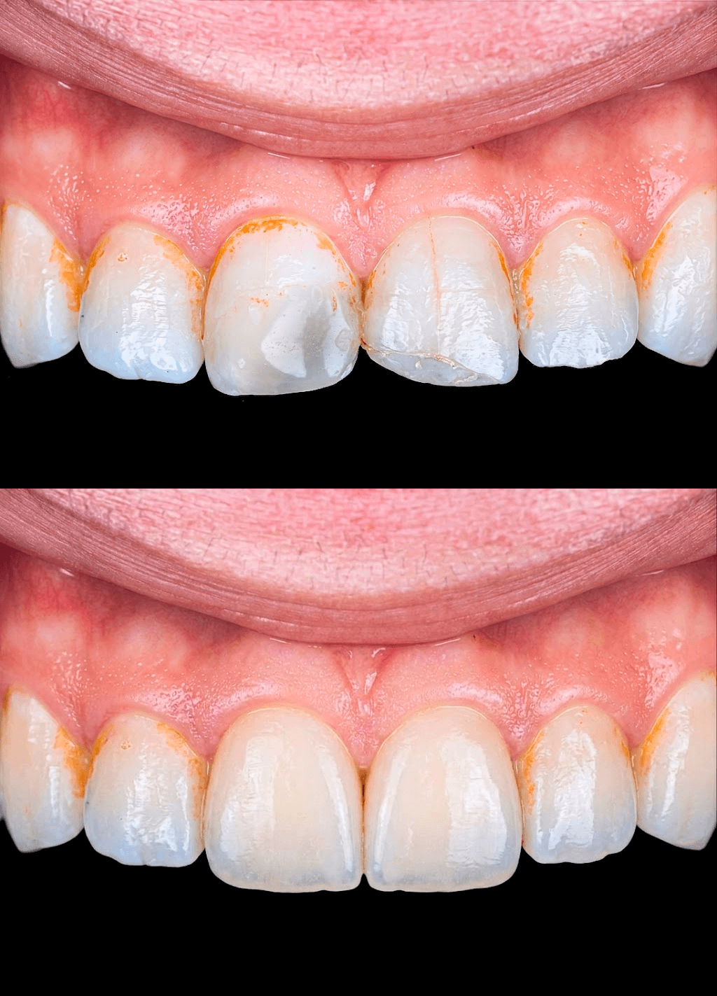 Antes e depois de restauração estética em resina — Dr. Luís Morato Divinópolis MG