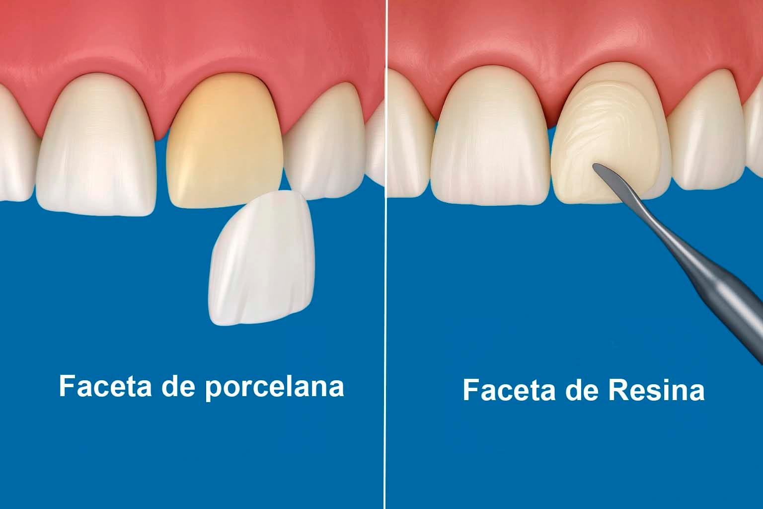 Faceta de porcelana e faceta de resina — comparativo de materiais — Dr. Luís Morato Divinópolis MG