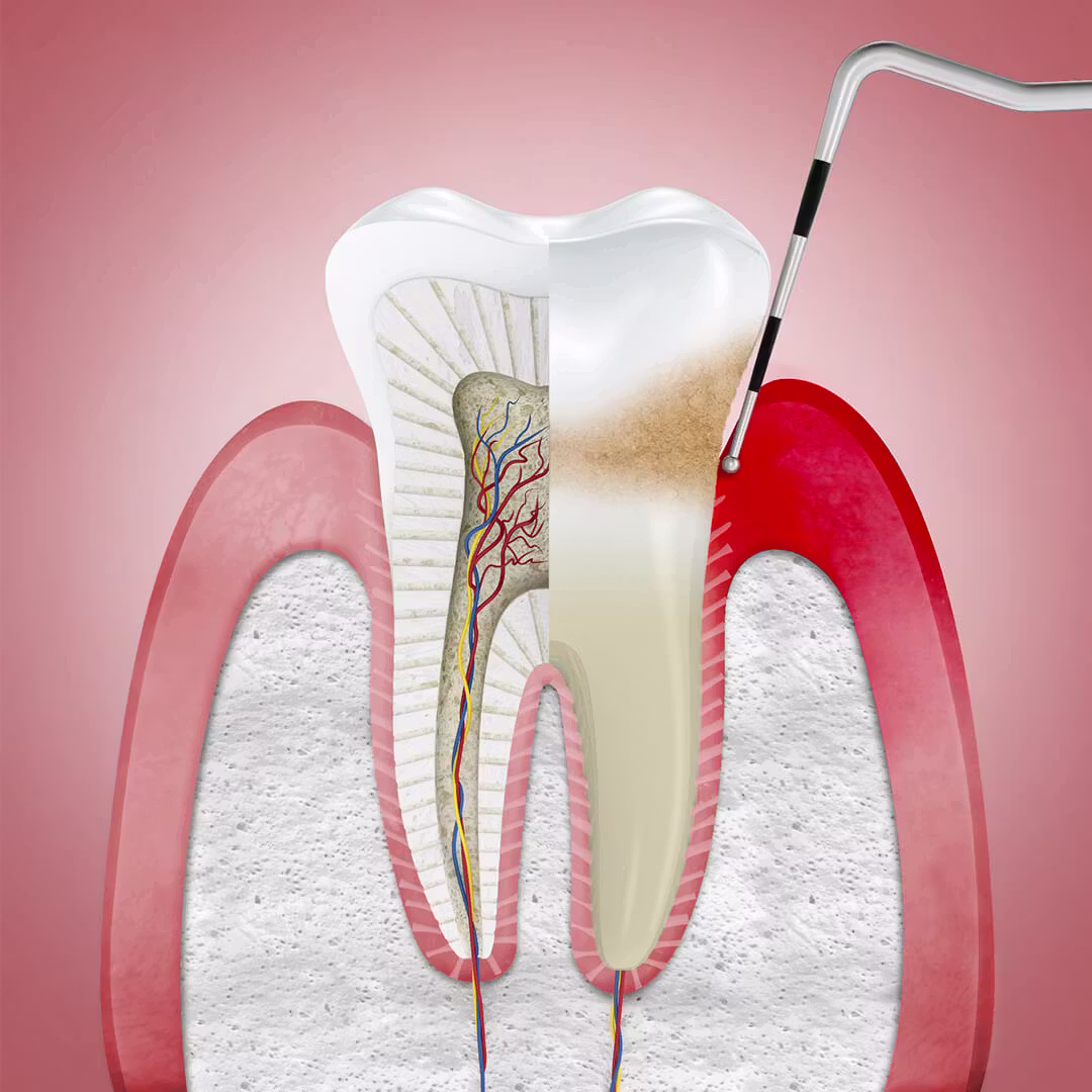 Gengivite — tártaro e inflamação na margem da gengiva