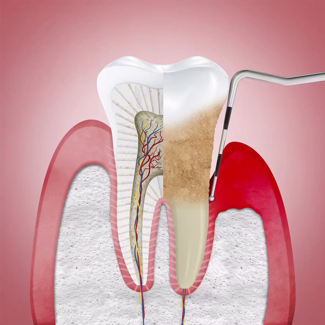 Periodontite — bolsa profunda e perda de osso ao redor do dente