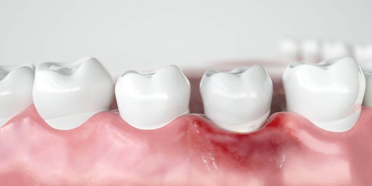 Gengivite — gengiva inflamada e avermelhada entre os dentes