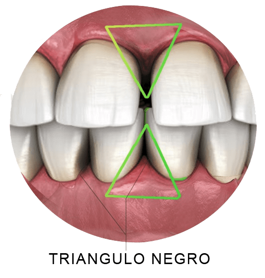 Triângulos negros — espaços escuros entre os dentes