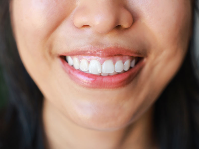 Estética gengival — gengiva rosa e bem contornada ao redor dos dentes