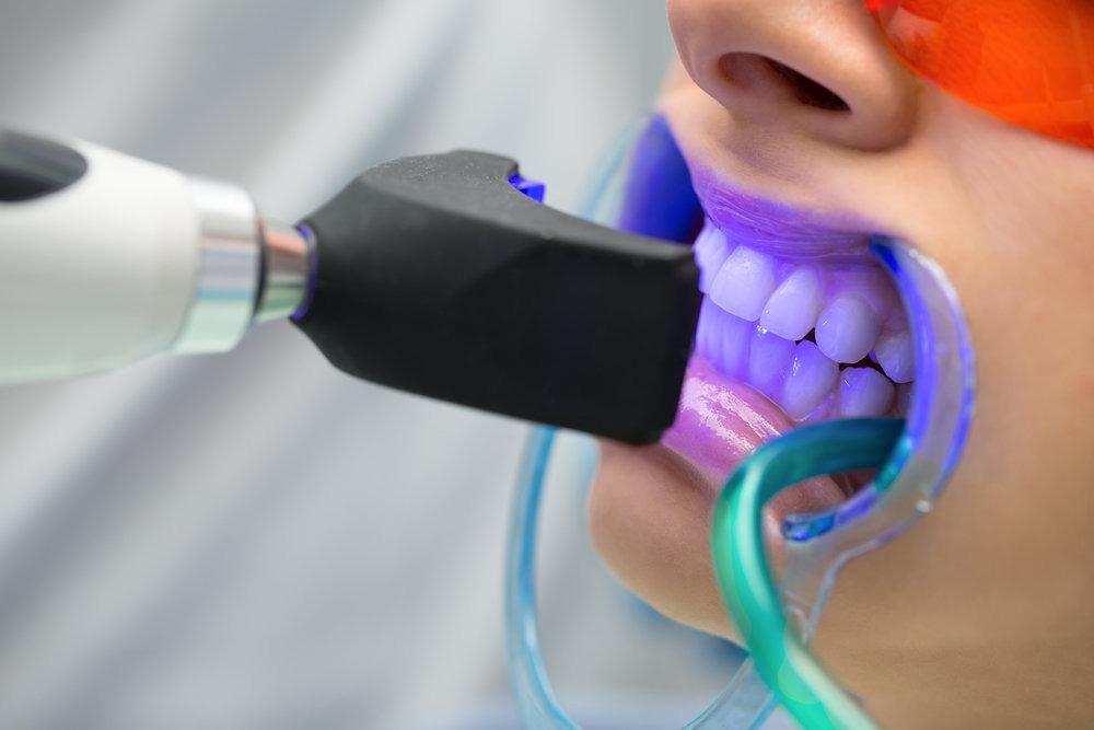 Clareamento dental em consultório em Divinópolis — aplicação do gel clareador