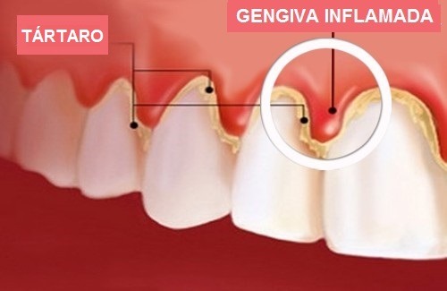 Gengiva inflamada e tártaro na margem — sangramento
