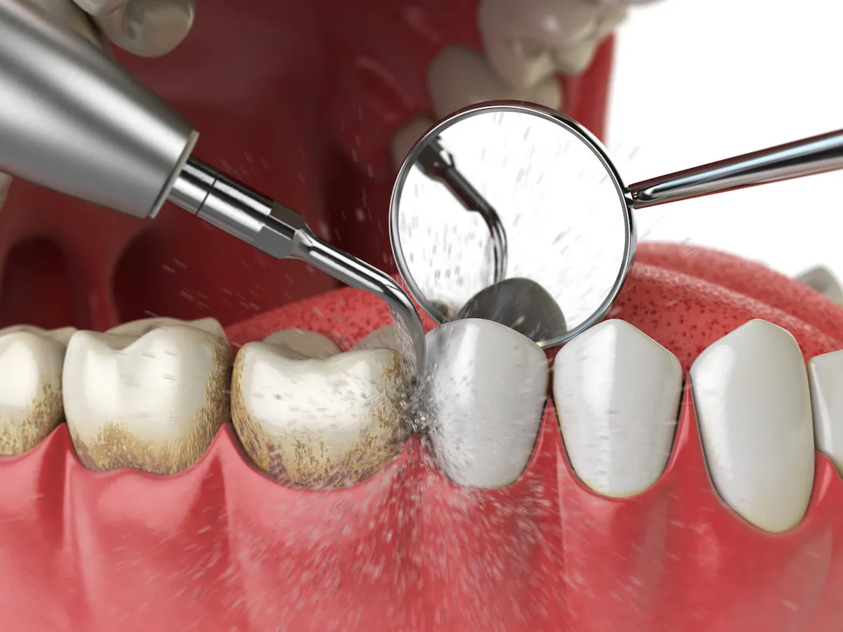 Limpeza dental profissional — tratamento da gengivite
