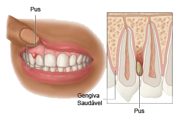 Bolinha na gengiva com pus — abscesso periodontal