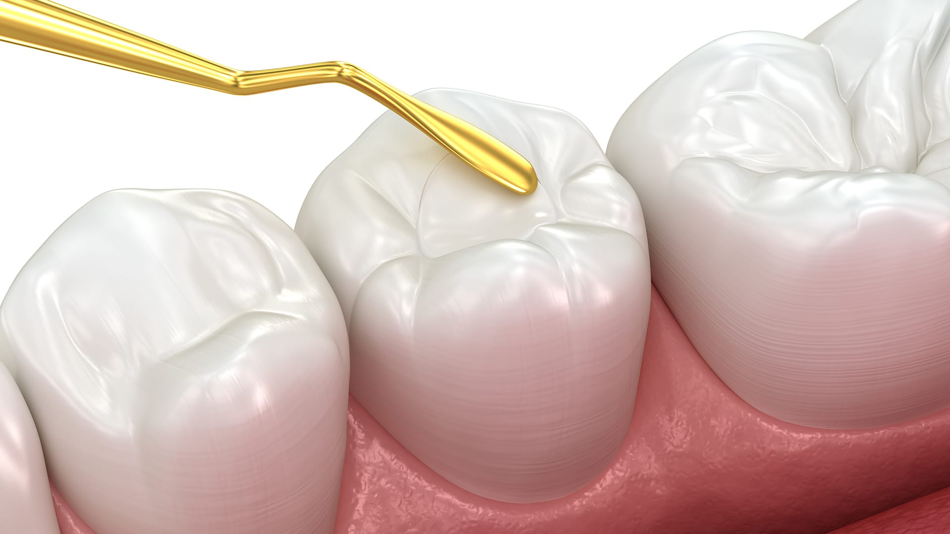 Restauração estética de resina em Divinópolis — Dr. Luís Morato