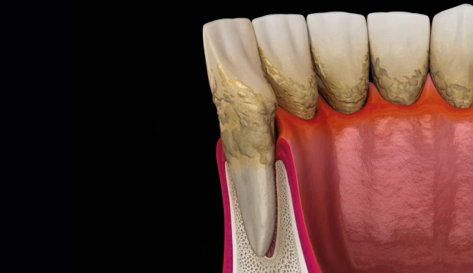 Tártaro acumulado abaixo da gengiva — cálculo dental
