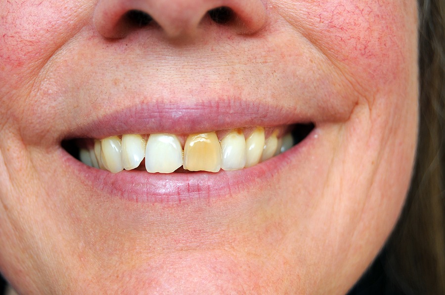 Sorriso com um dente escurecido