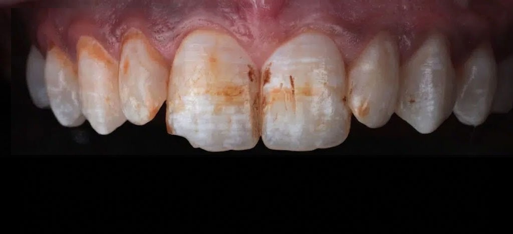 Etapa 1: esmalte manchado e desgastado