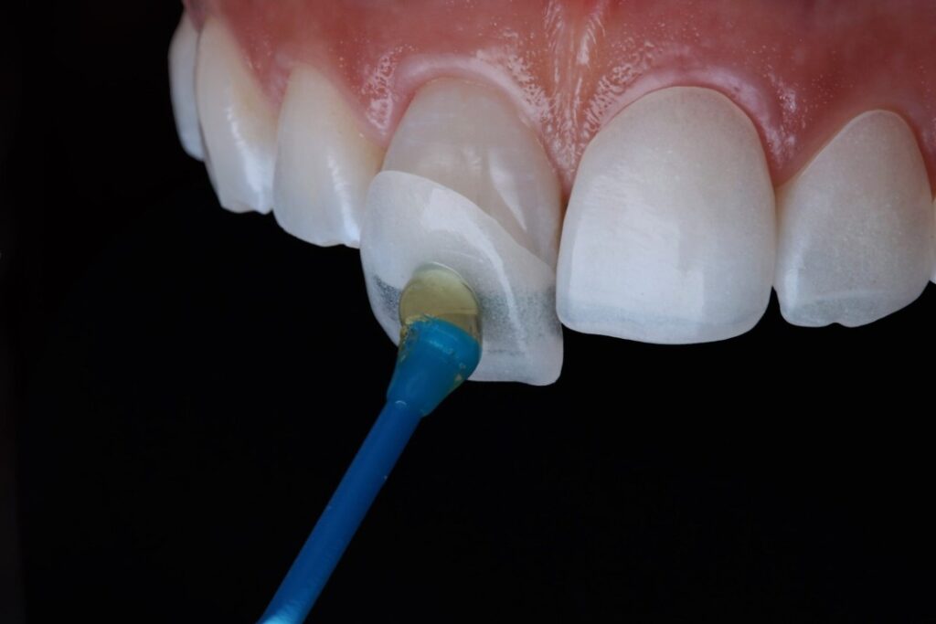 Lente de contato dental